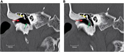 Middle Ear Surgeries for Chronic Otitis Media Improve Cognitive Functions and Quality of Life of Age-Related Hearing Loss Patients